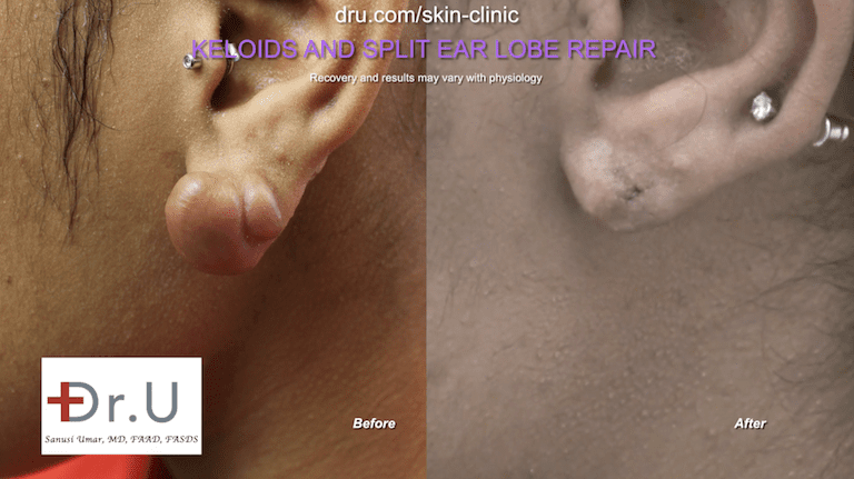 Home remedies for keloid scars on earlobes are not likely to be effective, which is why this patient sought expert care by Dr. U and his medical staff.