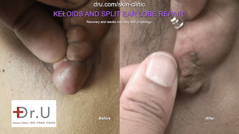 Frustrated with home remedies on how to get rid of keloids on ear, the Manhattan Beach patient turned to Dr. U for treatment. His unique and expertly executed removal methods allowed for the shape of the earlobe to be kept intact.