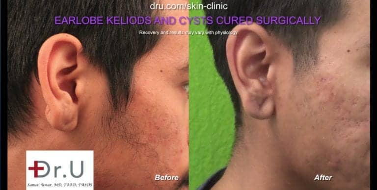 Long Beach, Los Angeles patient before and after his keloid cyst removal procedure performed by Dr. U.
