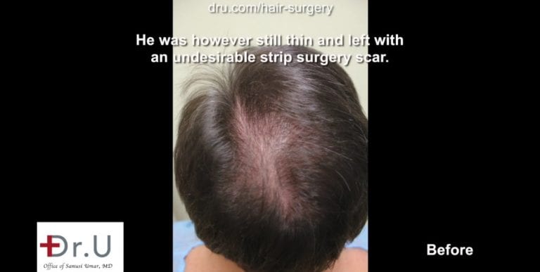Patient not only hopes for a hair transplant with a natural hairline, but also coverage for the areas of failed growth.