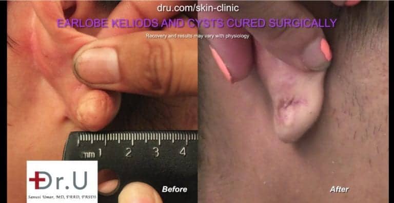 Patient's keloid cyst in the ear is completely gone after his removal surgery, with a normal appearance restored in the earlobe.