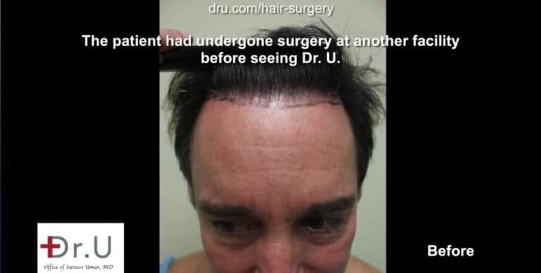Torrance, Los Angeles patient before his Dr.UGraft™ undetectable hairline transplant.