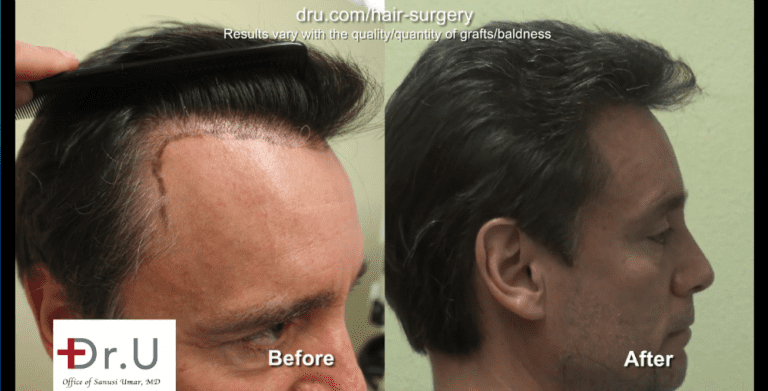 A hair transplant with a natural hairline must focus on the transition of the temples.