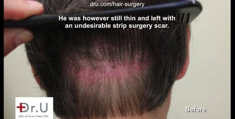 Many people ask, "does a hair transplant look natural" after a strip surgery with a large, obvious scar remaining