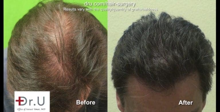 Does a hair transplant look natural? Dr.U's results show that the answer to this question is a resounding yes.