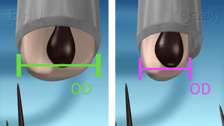 In this photo, the relationship between FUE punch diameter and graft size is illustrated clearly.