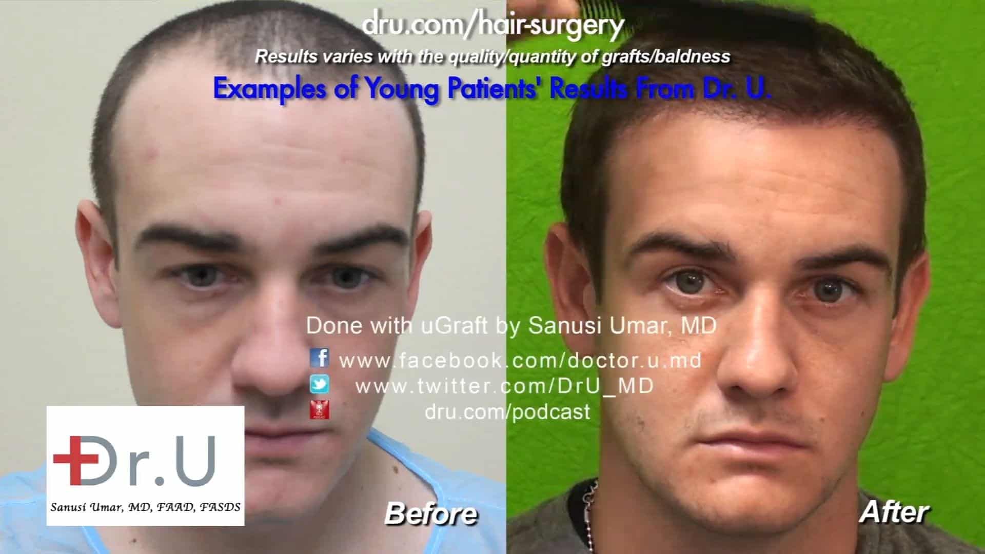 Young Patient Hair Transplant