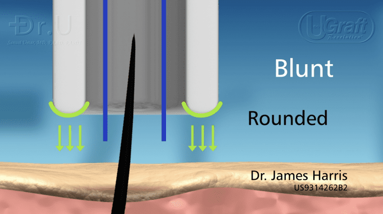 Rounded FUE punch tips such as this one have the ability to protect the graft from accidental transection. Rounded FUE punch tips such as this one have the ability to protect the graft from accidental transection.