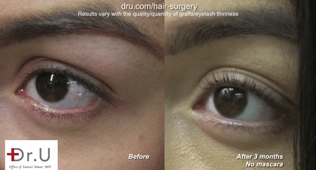 Dr. U was able to perform this BHT eyelash restoration with leg hair. These are the extraordinary results.*