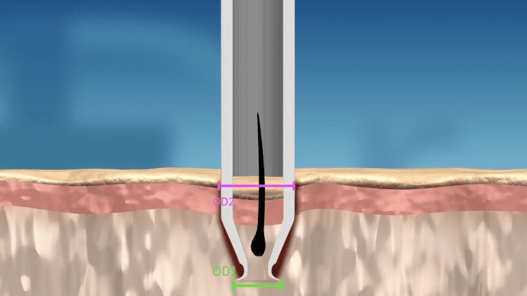 As the body of the punch widens, the opening of the wound is gently stretched to OD2.