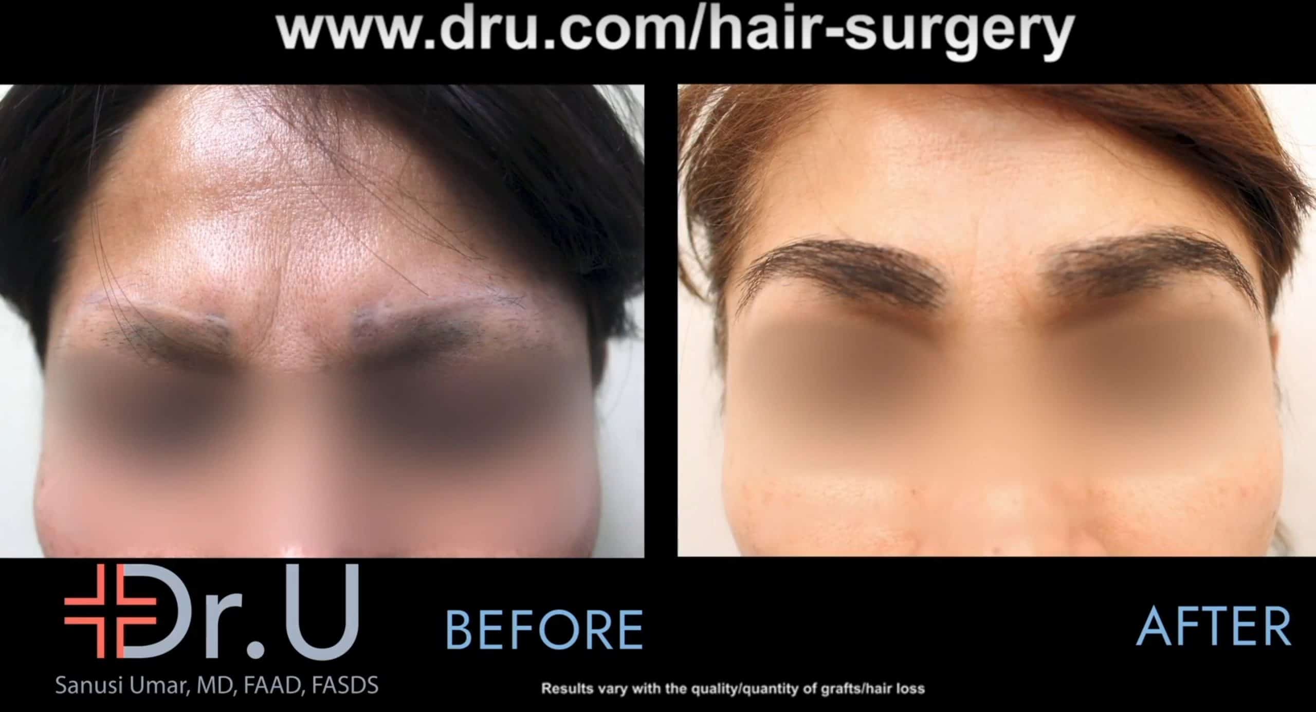 A Los Angeles patient before and after her eyebrow repair that corrected eyebrow discoloration and scarring.