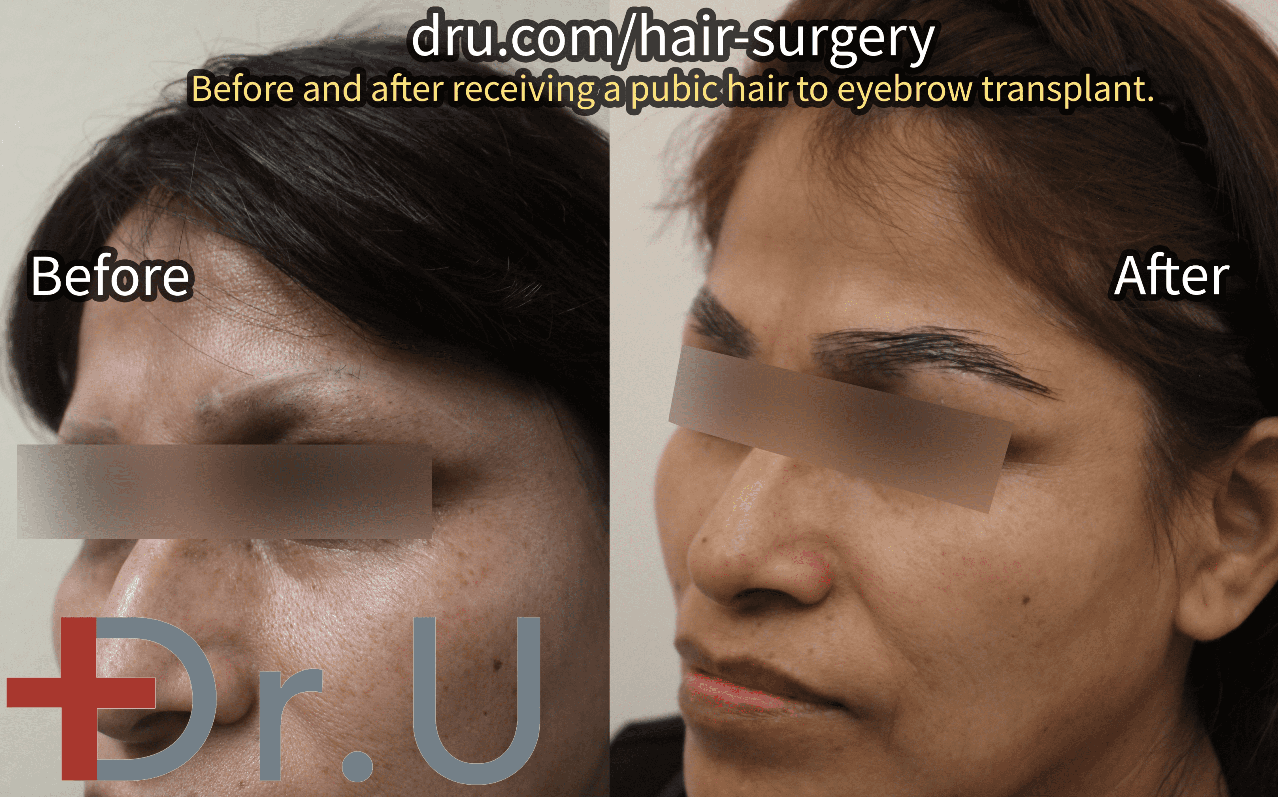 A Dr.UGraft™ eyebrow repair, before and after.*