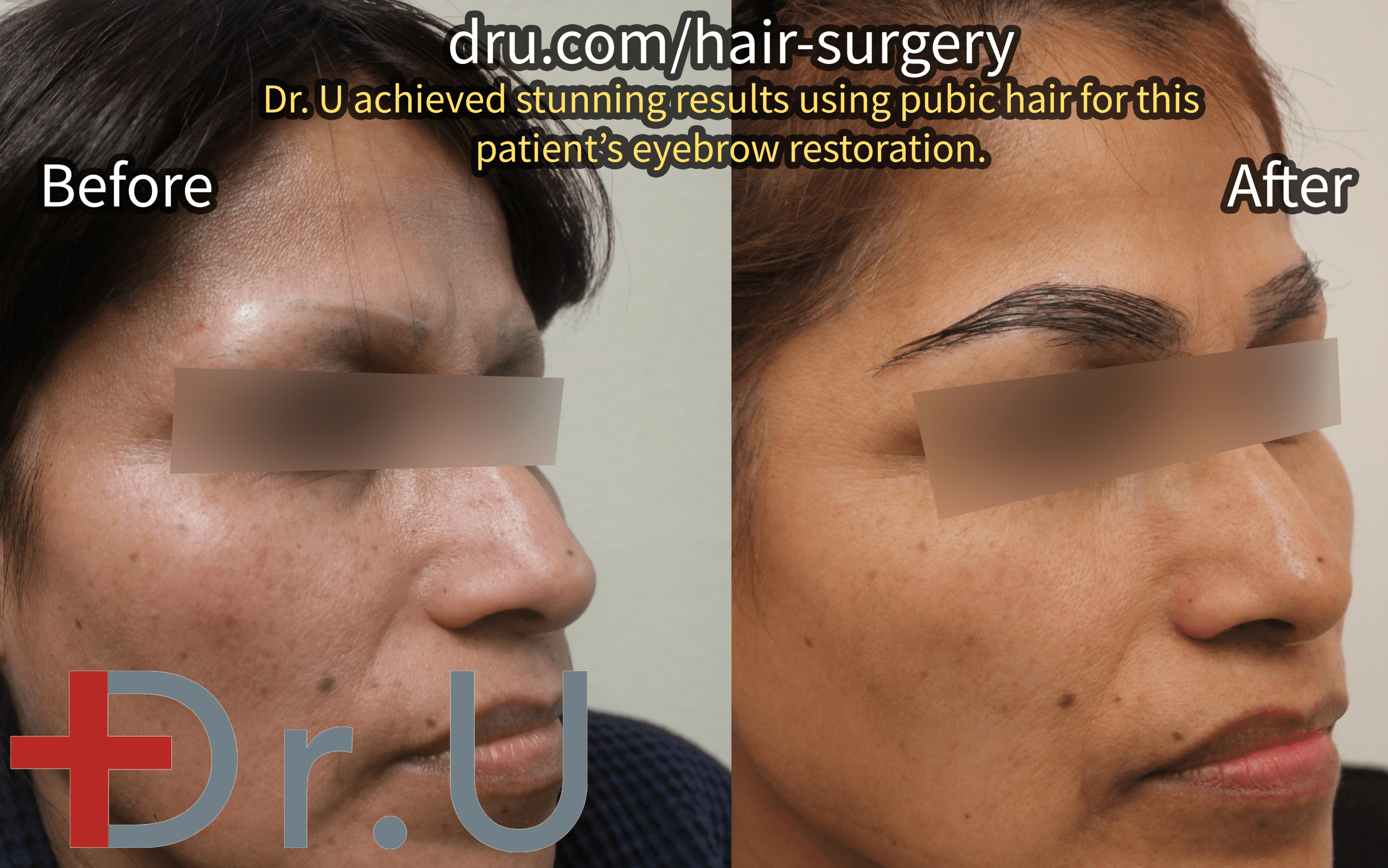 The patient’s eyebrow scar repair before and after photos.*
