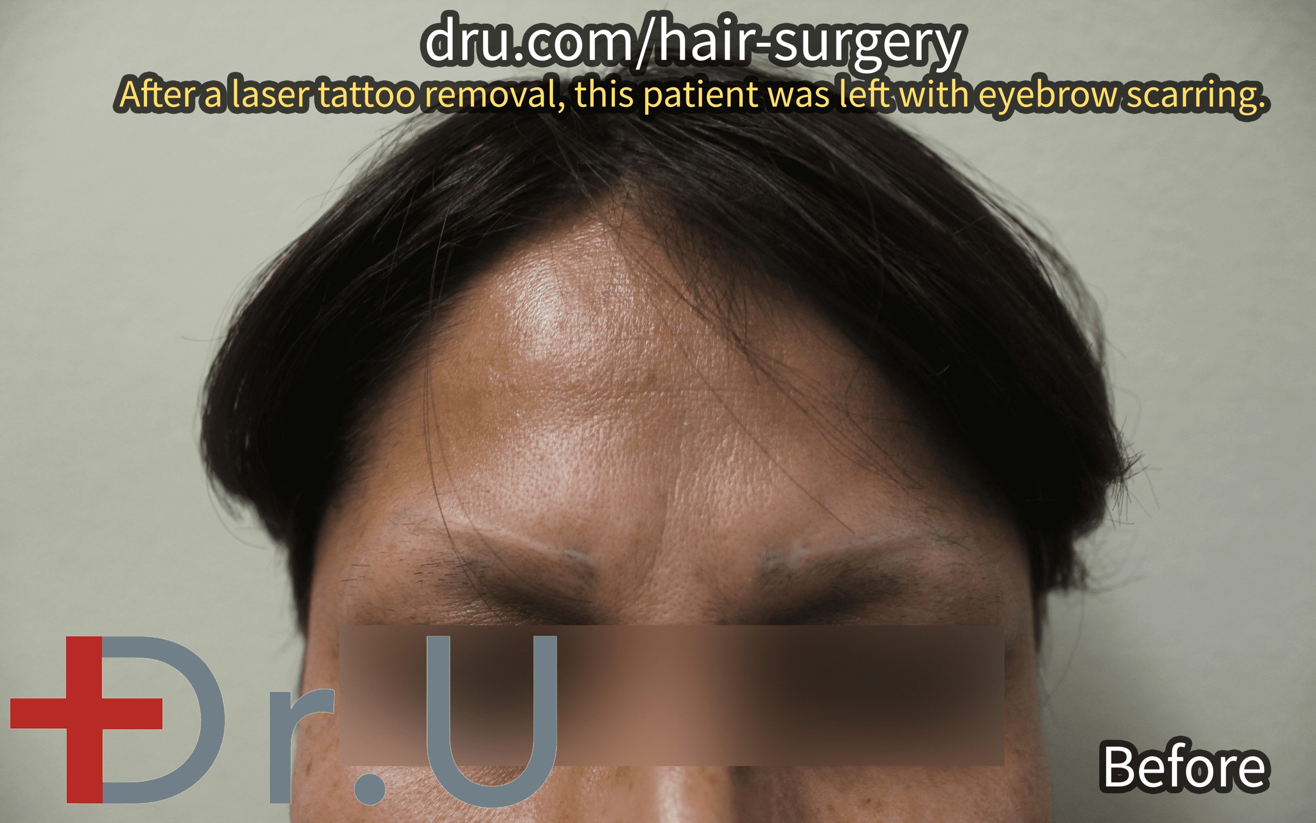 The California patient before her second eyebrow loss and tattoo scar repair surgery. She sought to diminish the appearance of her eyebrow scars.