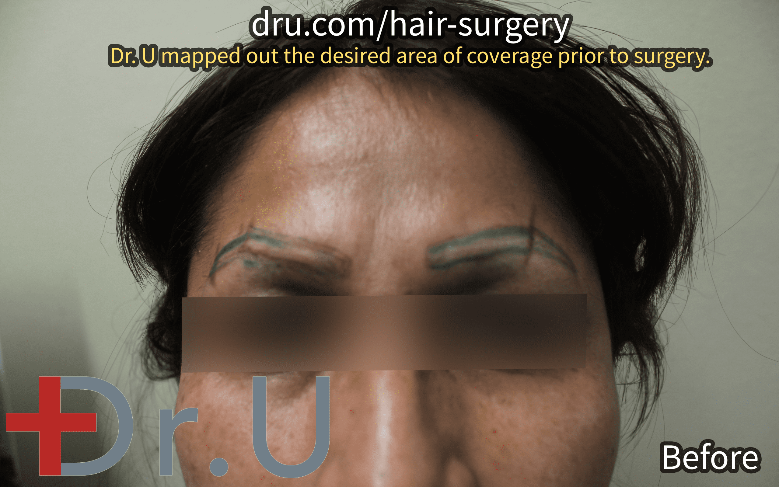 Dr. U mapped out the shape of the patient’s eyebrows as they grew prior to her laser tattoo removal.