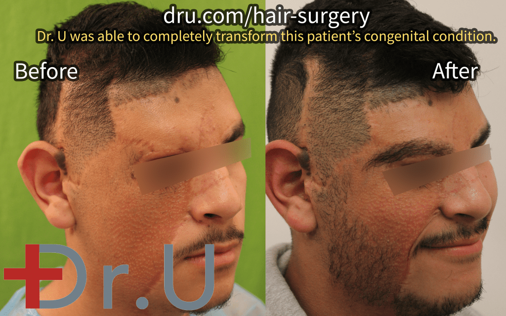 This patient came to Dr. U looking to construct his right eyebrow and the right side of his beard. Donor sources utilized include the scalp, nape, and legs.*
