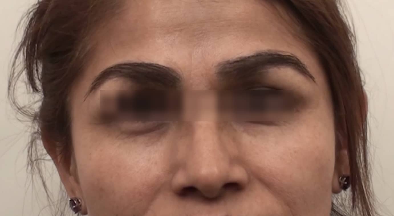 Eyebrow repair