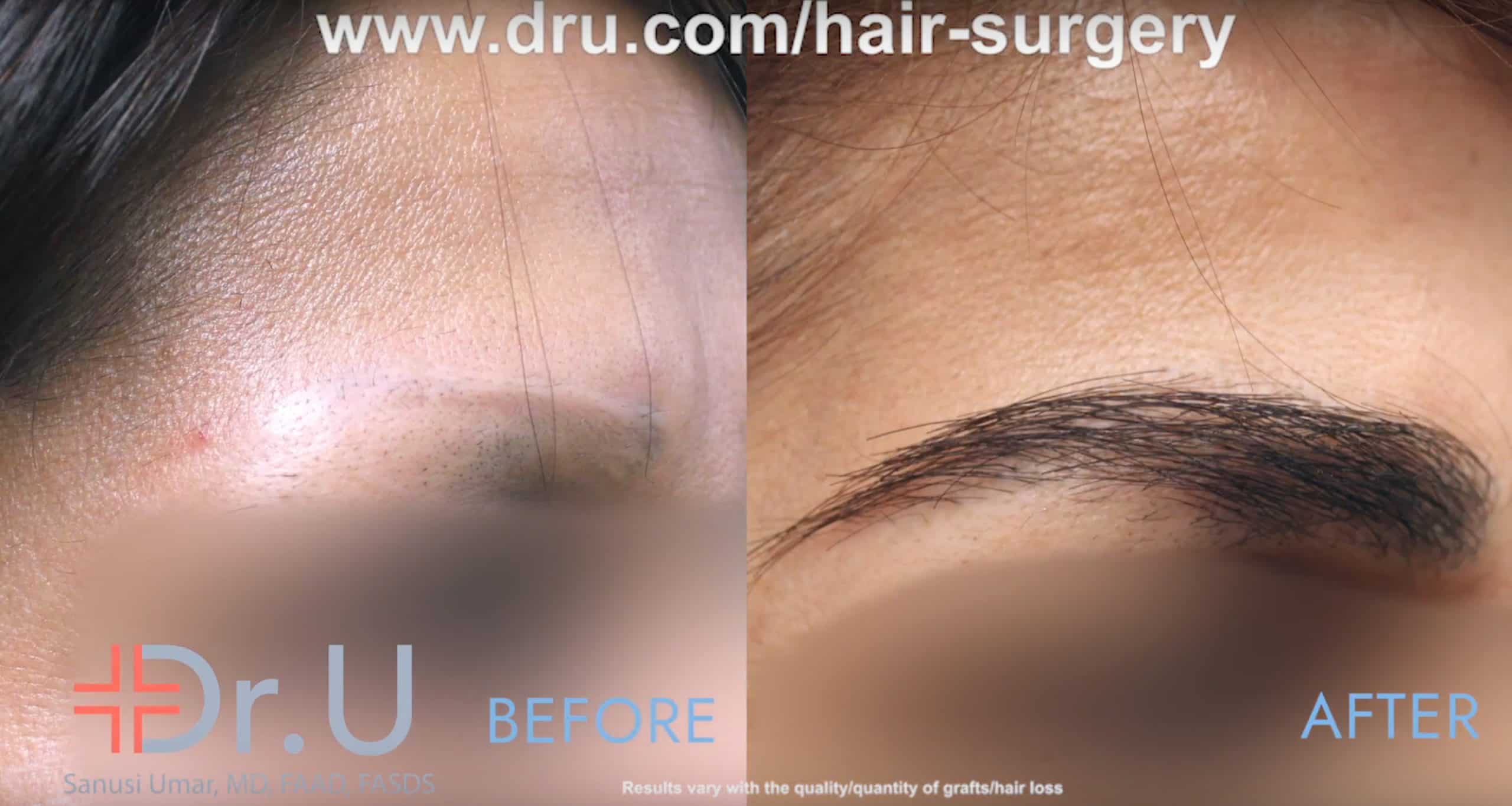 Though pubic hair may be an unusual choice for an FUE donor area in an eyebrow repair the patient's results have a real eyebrow texture with a natural look.