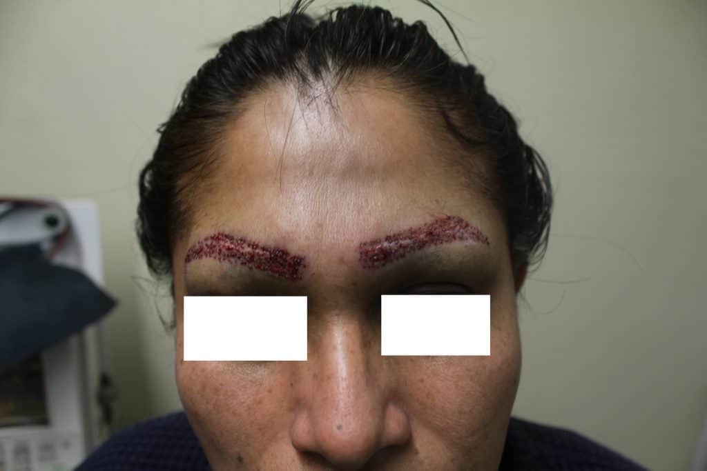 Patient undergoing UGraft eyebrow repair, shown soon after implantation of pubic derived hair grafts