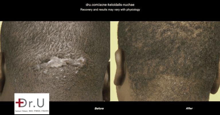 Before and after images of Dr.U's patient who underwent Acne Keloidalis Nuchae removal with Trichophytic excision and closure Before and after images of Dr.U's patient who underwent Acne Keloidalis Nuchae removal with Trichophytic excision and closure