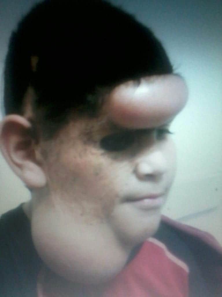 Patient shown undergoing balloon expansion which aims to stretch the skin and create extra tissue for replacing the congenital nevus mole areas on the face 