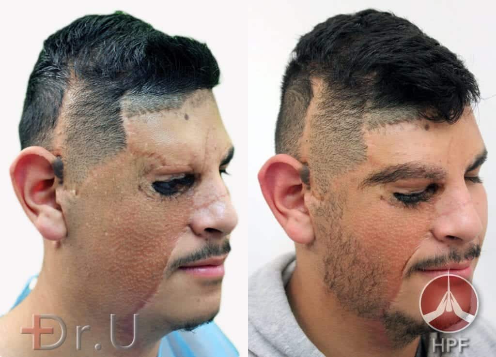 Close up of the left side of Dr.U's beard transplant which helped to improve this patient's facial appearance, following skin graft procedures which replaced his congenital facial nevus (i.e. mole) 