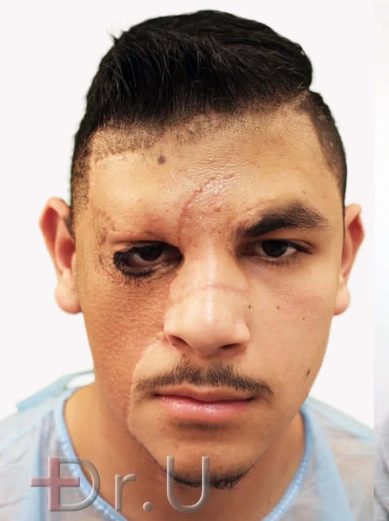 Alex before his facial hair restoration for the right eyebrow and bear