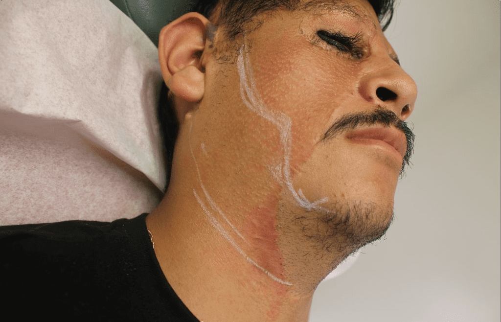 Dr.U plans out the area where grafts will be inserted for the patient's beard and sideburn hair transplant