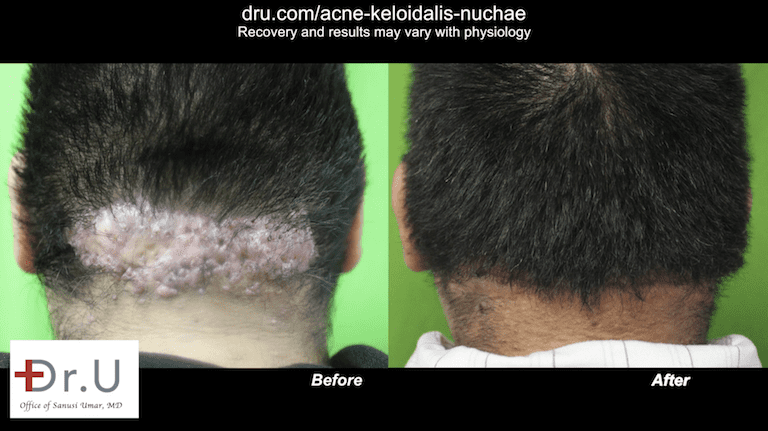 With Dr.U's bat excision method, the scar actually defines the posterior hairline