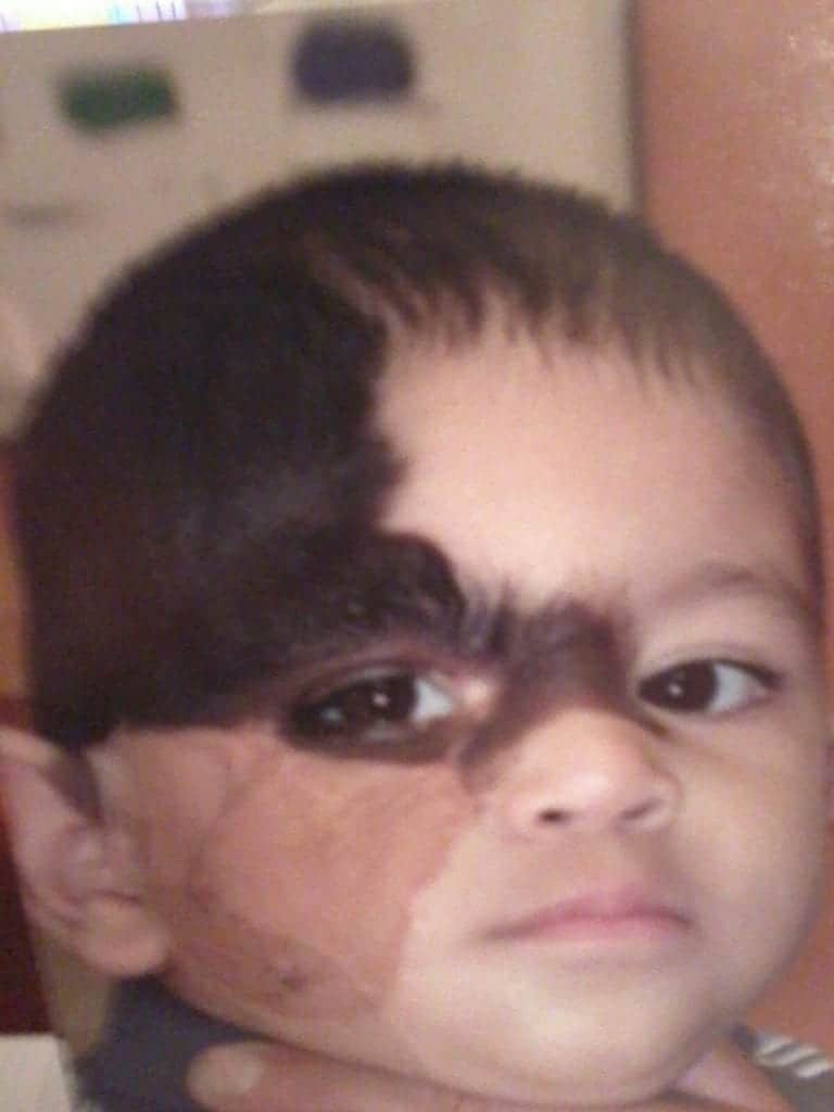 Los Angeles patient was born with a congenital nevus, undergoing several plastic surgeries to remove sections of the darkened skin. 