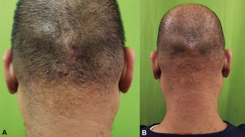 Example of level 2 AKN patient within Dr .U's patient classification system for laser treatment*