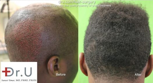 Before and After: FUE for hair restoration in black African men