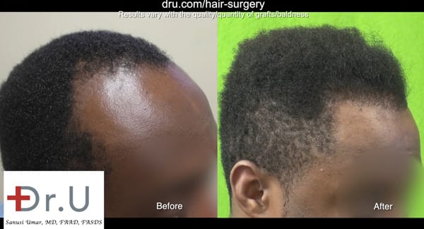African American hair transplant before after results of the Dr UGraft procedure
