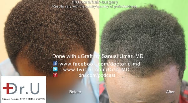 Dr. Umar used 1600 grafts for black hair restoration