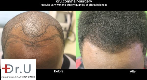 Hairline restoration in a patient of African descent