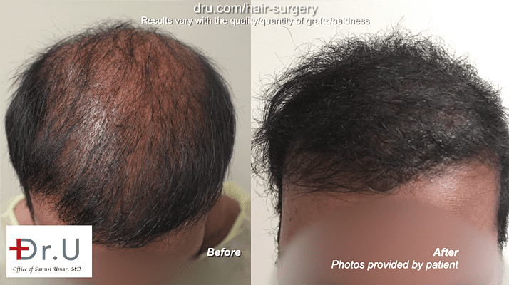 Body Hair Transplant: The DrUGraft method restored this patient's hair to fullness Body Hair Transplant: The DrUGraft method restored this patient's hair to fullness