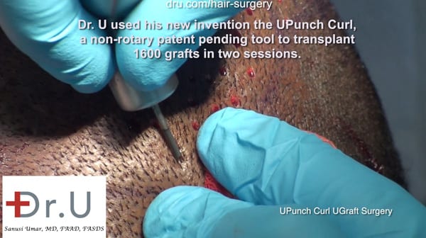 Dr. Umar performes FUE hair restoration in black African men with the DrUPunch Curl