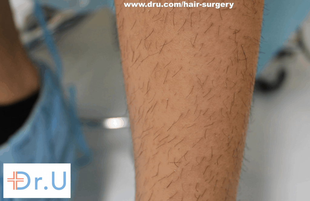 leg hair used for eyelash transplant