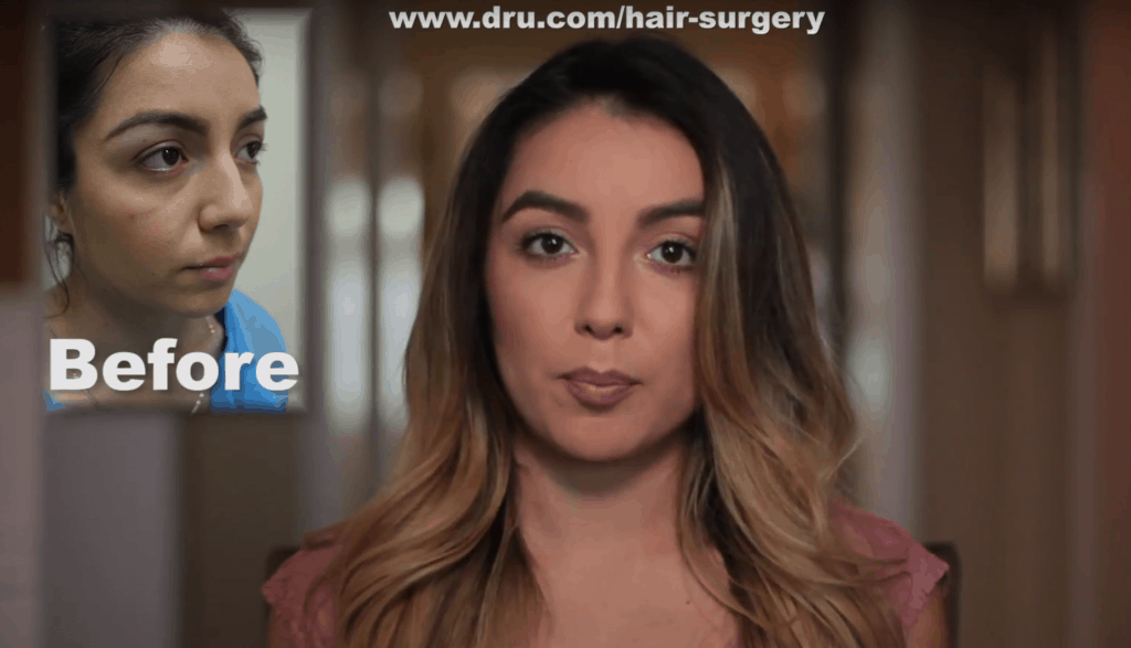 before and after eyelash transplant