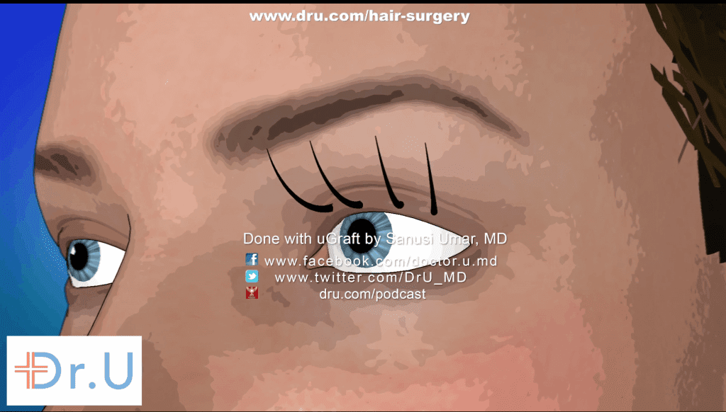 VeeLashe eyelash transplant