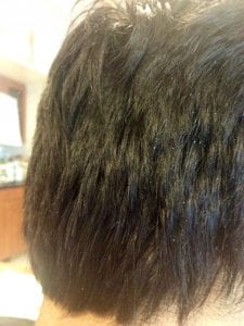 Any sebhorrheic dermatitis ( Dandruff ) observred before a hair transplant must be aggressively treated for a prolonged period after the surgery to avoid compromising the ultimate results. The treatment and regimen that must not negatively impact the result must be utilized must not impact the result negatively also.