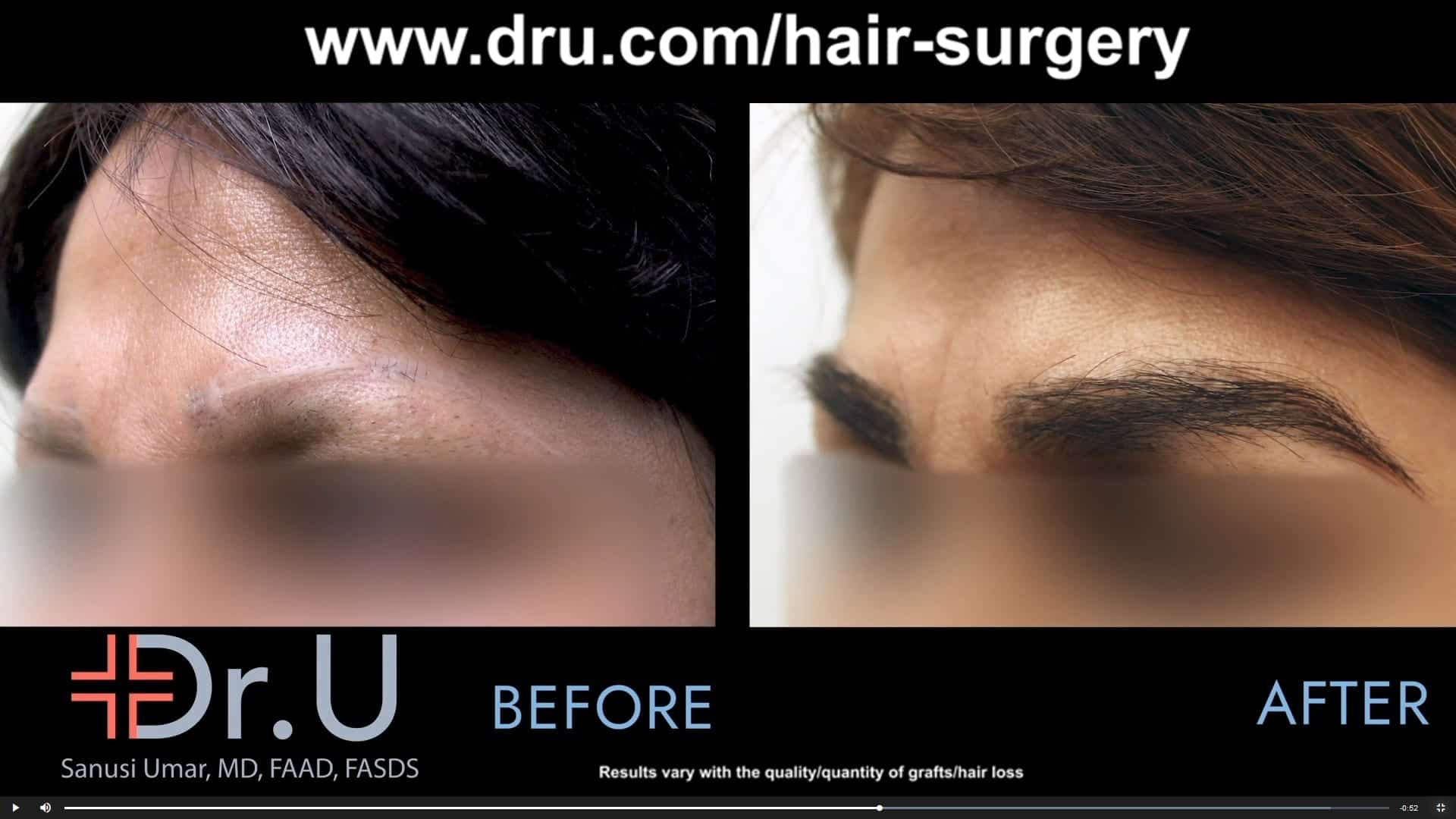 After a pubic hair to eyebrow transplant, this Los Angeles patient was able to restore a natural looking eyebrow that no longer looked scared or had eyebrow discoloration.*