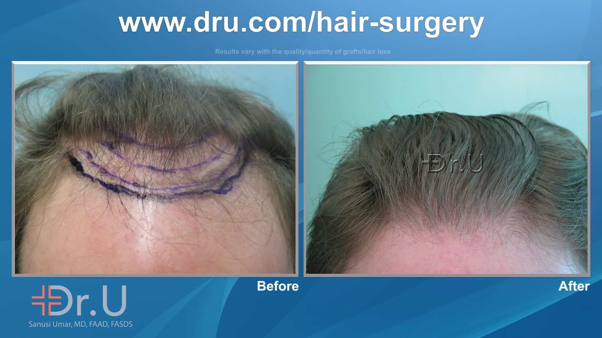 Mature Hair Transplant Coverage Sustains A Fuller Look In Beverly Hills Norwood 3 Patient - Dr U
