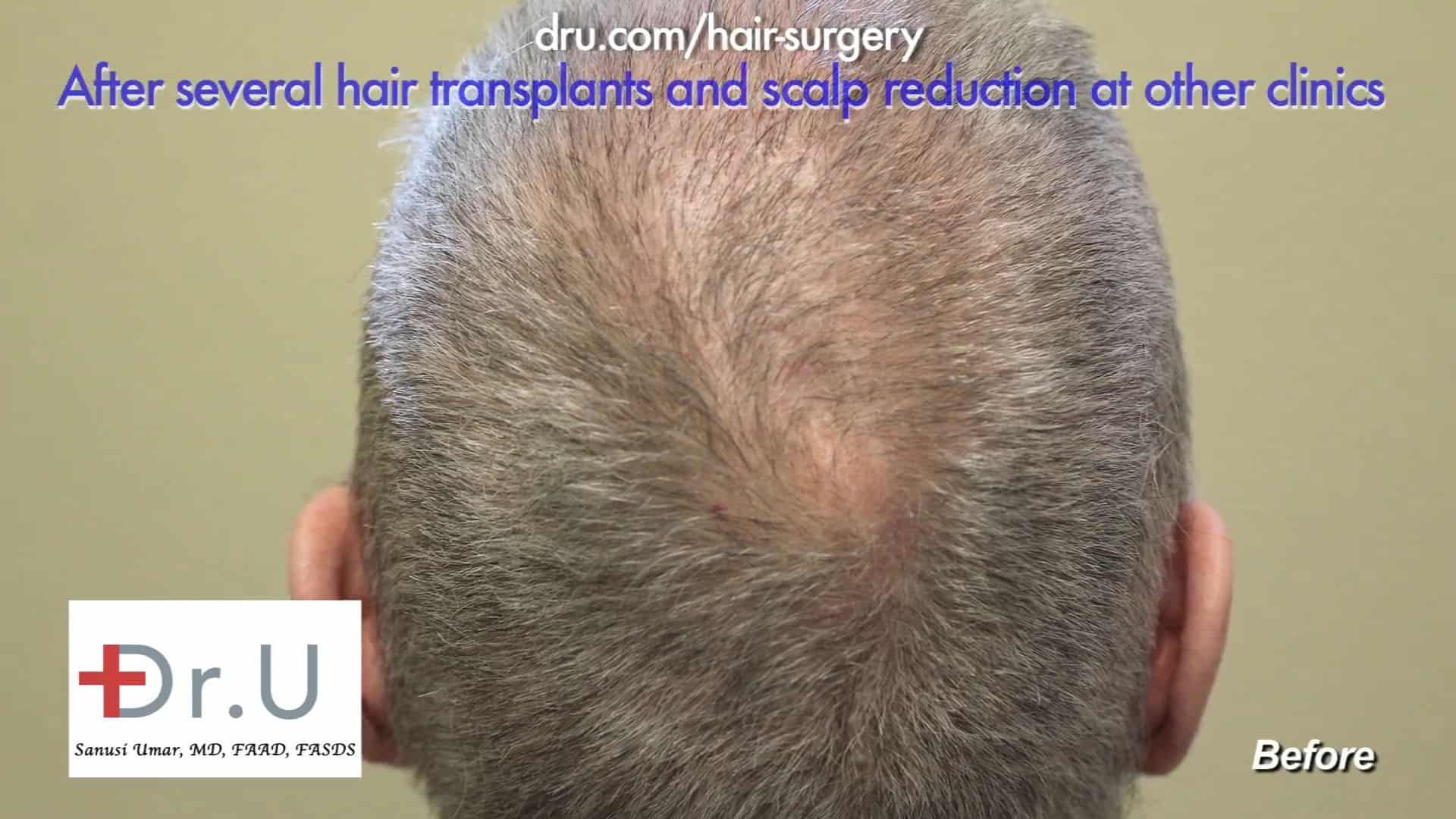 Scalp Reduction and Progressive Hair Loss Repair by Dr.UGraft