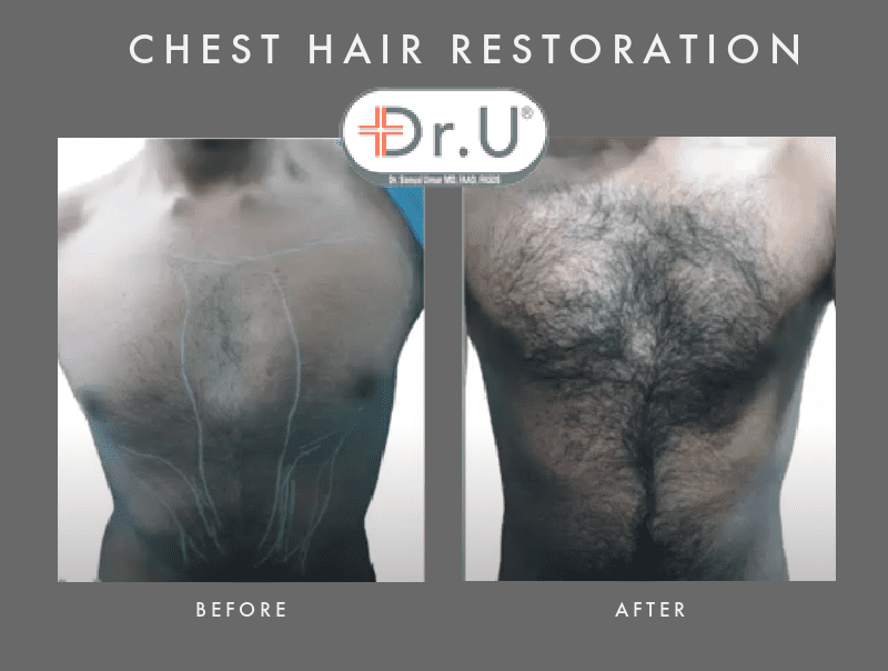 60-Sec-Chest-hair-restoration