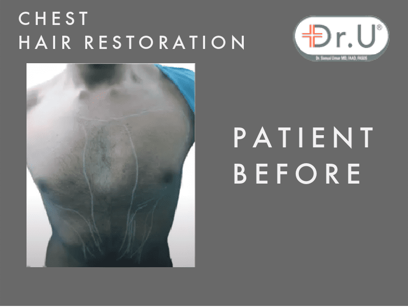 Dr.U's Los Angeles Head to Chest Hair Transplant Patient Before Procedure Dr.U's Los Angeles Head to Chest Hair Transplant Patient Before Procedure