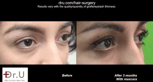 This Dr.UGraft ™ patient represents the world’s first case using leg hair as donor grafts for an eyelash transplant procedure.