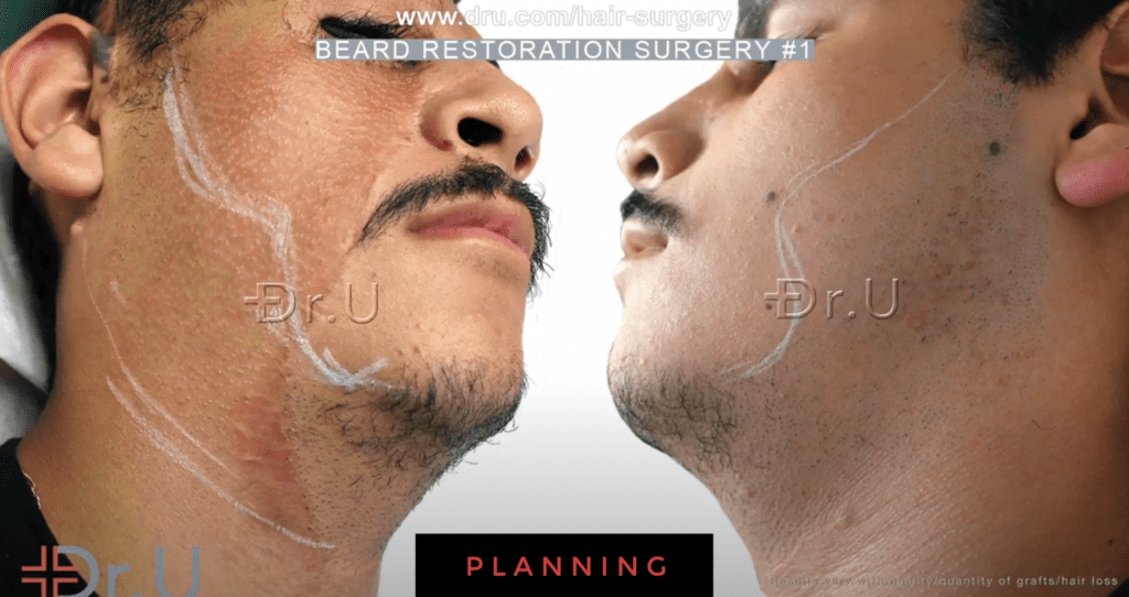 Dr.U marks off the regions and shape of the patient's overall beard reconstruction results