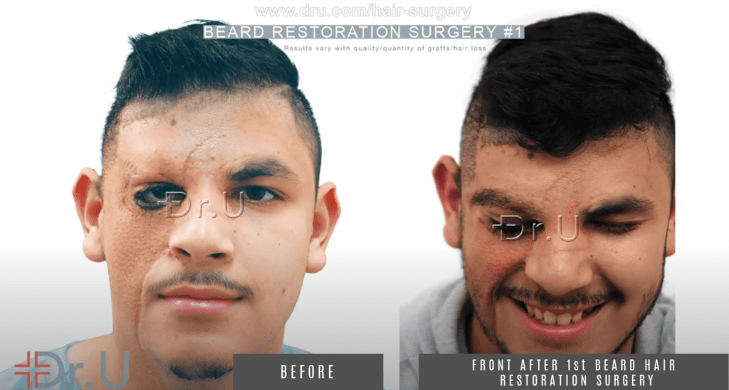 Patient is please with his complete beard results after his first procedure with Dr.u 