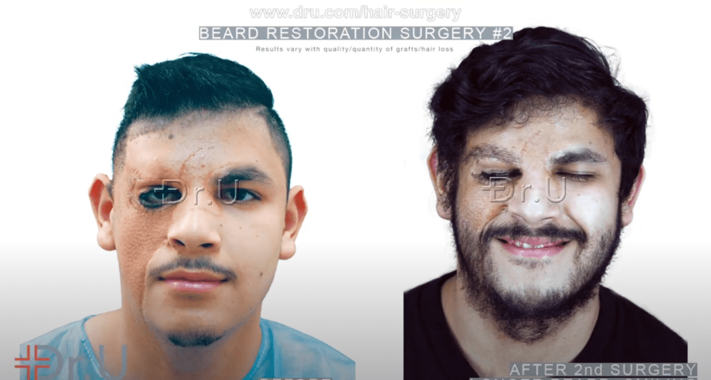 Patient shown before his beard restoration and after his second procedure*